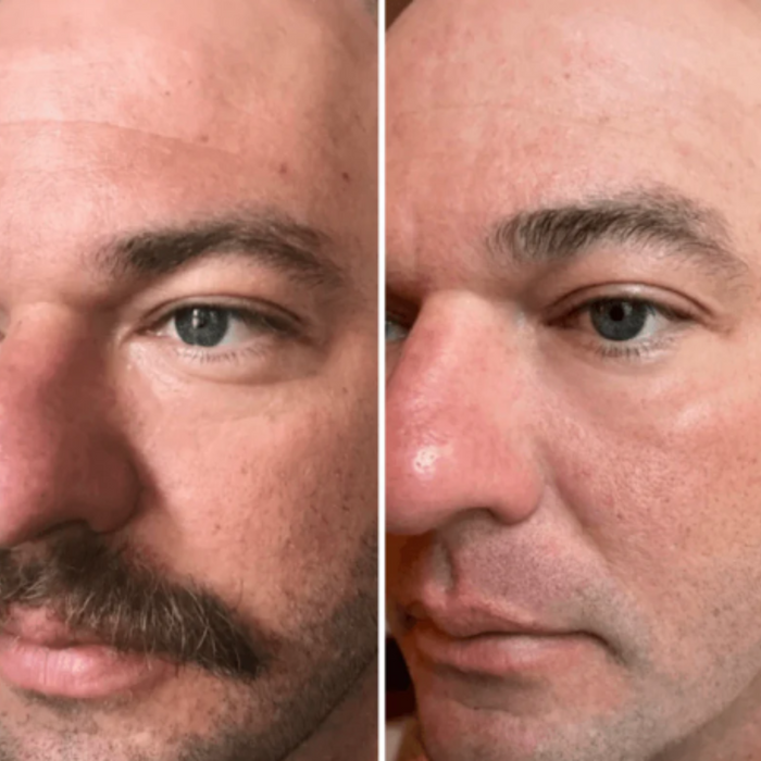 OMNILUX - Contour Face LED Therapy
