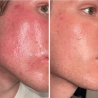 OMNILUX - Contour Face LED Therapy