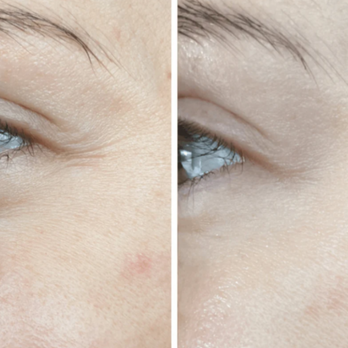 OMNILUX - Contour Face LED Therapy